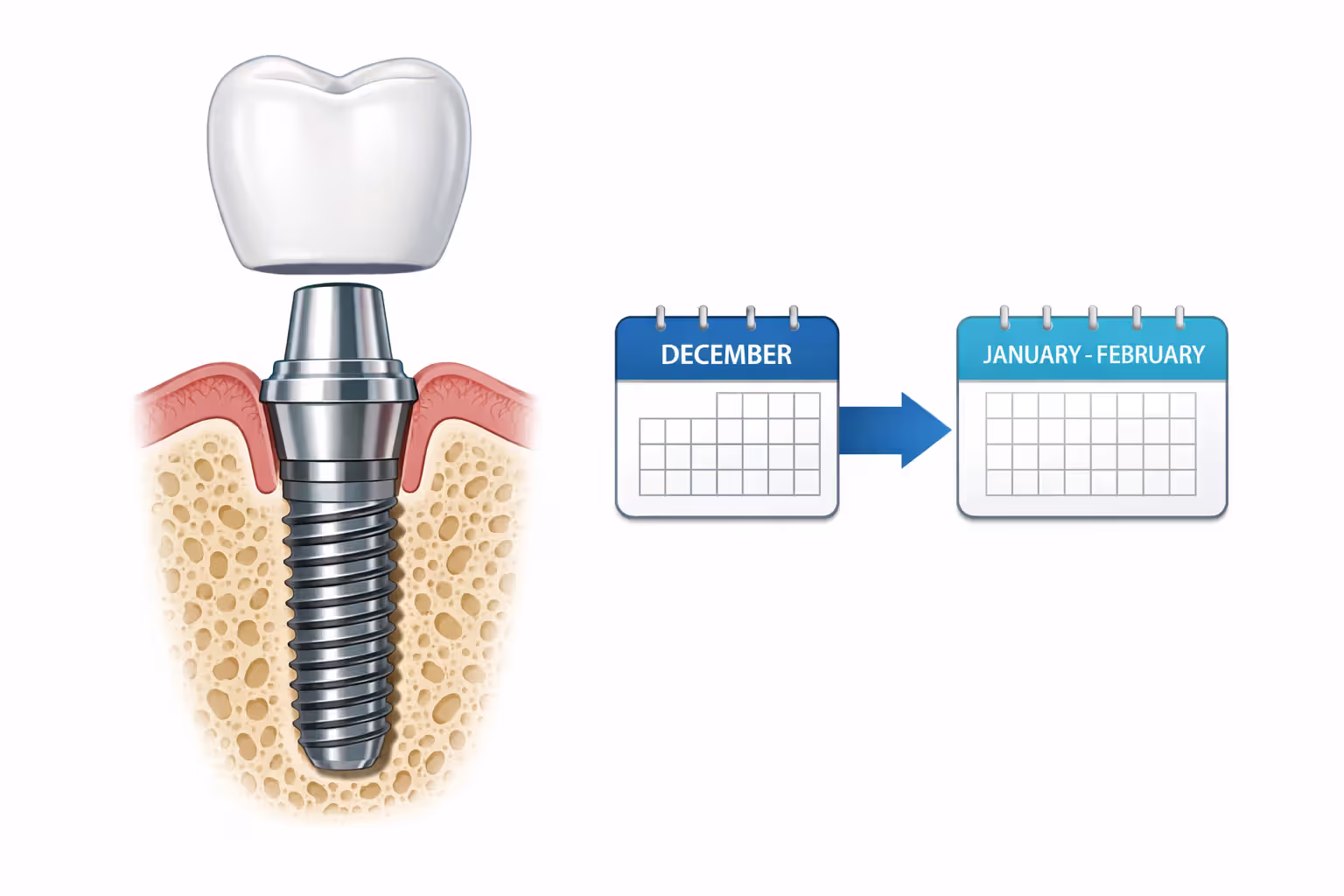 A medical illustration showing a cross-section of a dental implant with its three components (titanium post, abutment, and crown) alongside a simplified two-year calendar diagram showing strategic procedure timing split across calendar years