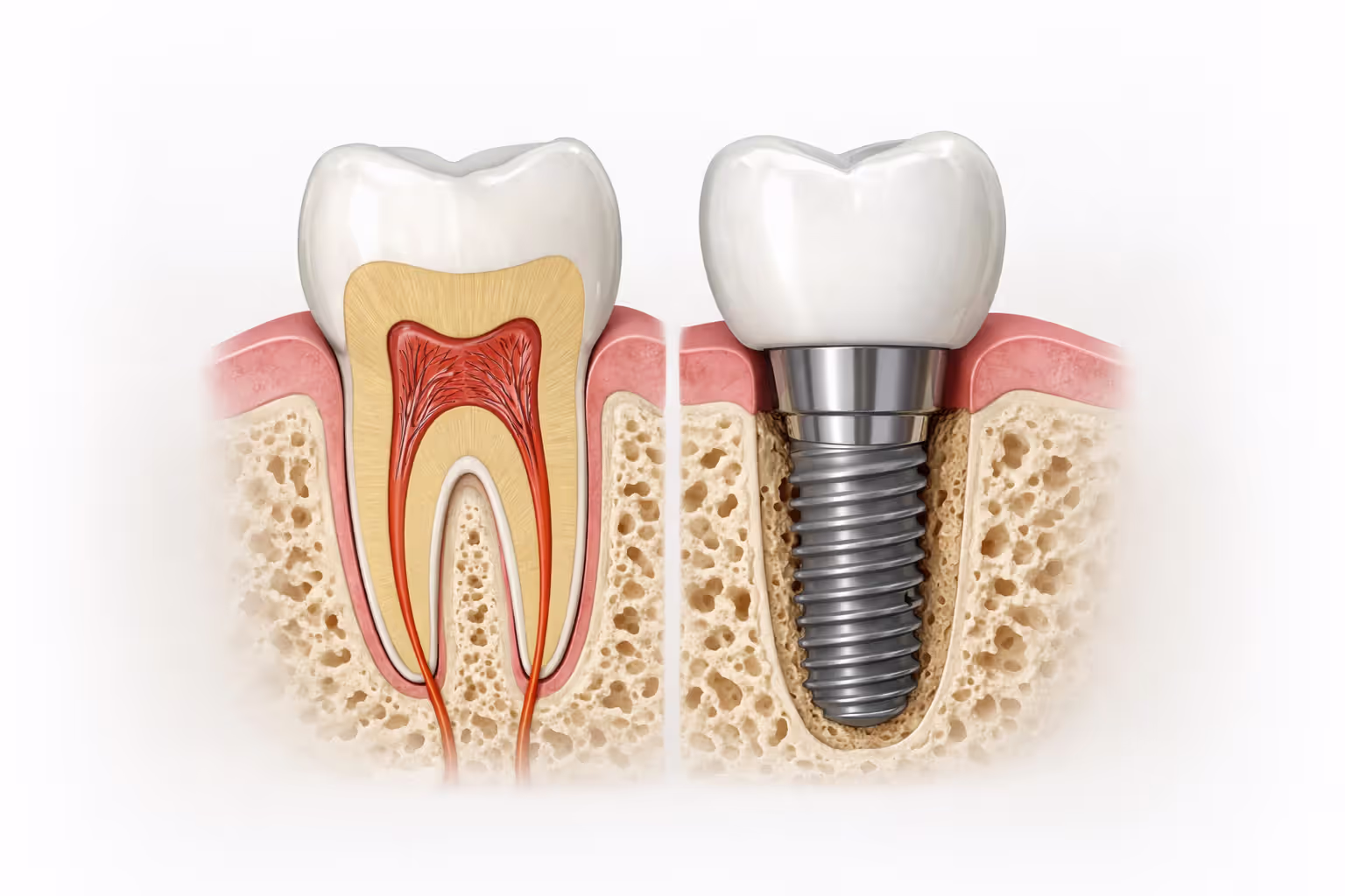 Medical illustration showing cross-section of dental implant with titanium post abutment and crown compared to natural tooth
